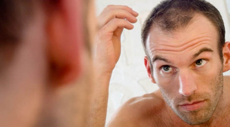 7 πράγματα που πρέπει να γνωρίζετε για την φαλάκρα