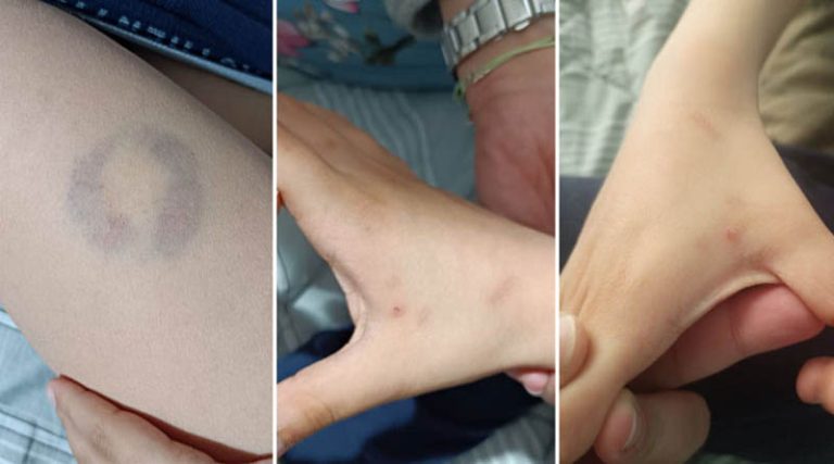 Απίστευτο περιστατικό: Διευθύντρια σχολείου δάγκωσε 11χρονο μαθητή ΑΜΕΑ! (φωτό)